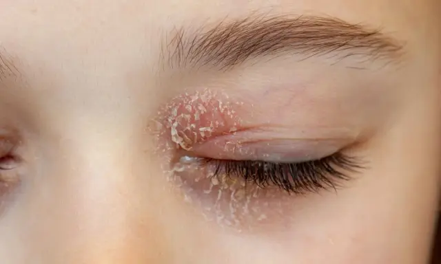 Paupière rouge et irritée avec une plaque rouge sous les yeux allergie, la peau pèle.