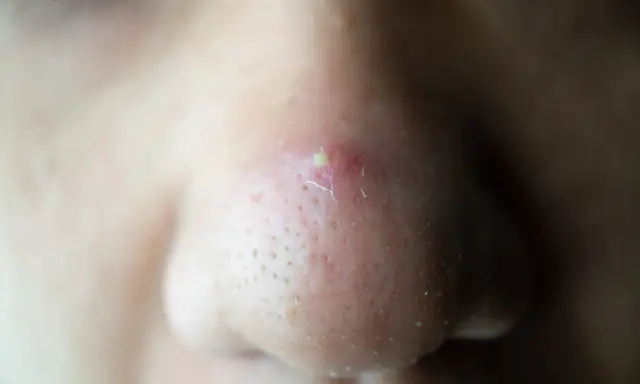 Gros plan sur un nez avec un point noir douloureux et enflammé, entouré de pores visibles.