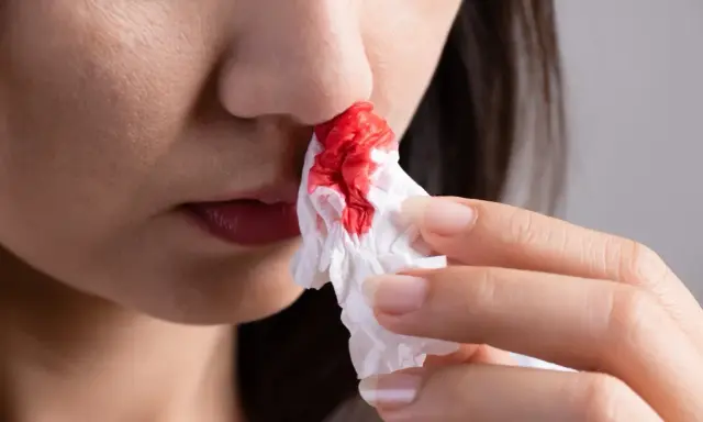 Une personne utilise un mouchoir pour éponger le sang des ailes du nez rouge.