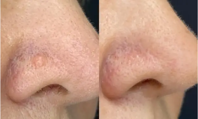 Comparaison avant/après traitement d'une papule fibreuse du nez. La lésion a disparu.
