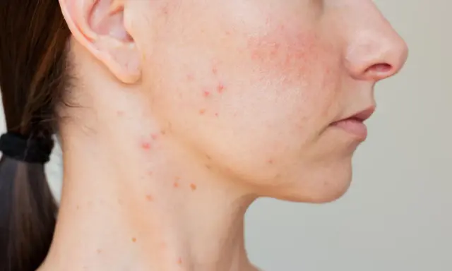 Peau du bas du visage avec des rougeurs et un bouton.