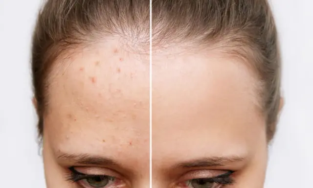 Avant/après : front avec acné et front lisse. L'acide salicylique bienfait pour une peau nette.