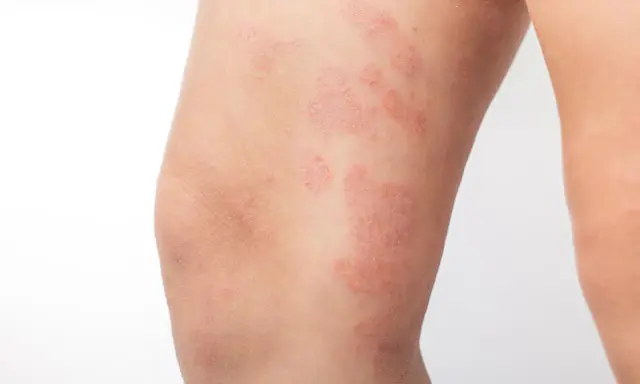 Plaques rouges et squameuses sur la jambe, caractéristiques de l'eczéma nummulaire.