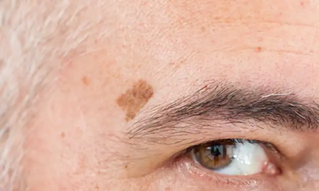 Gros plan sur un œil et un sourcil, avec une tache vieillesse brune sur le front.