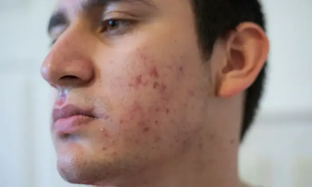 Visage d'un jeune homme avec des rougeurs et des boutons, signes d'acné nodulaire.