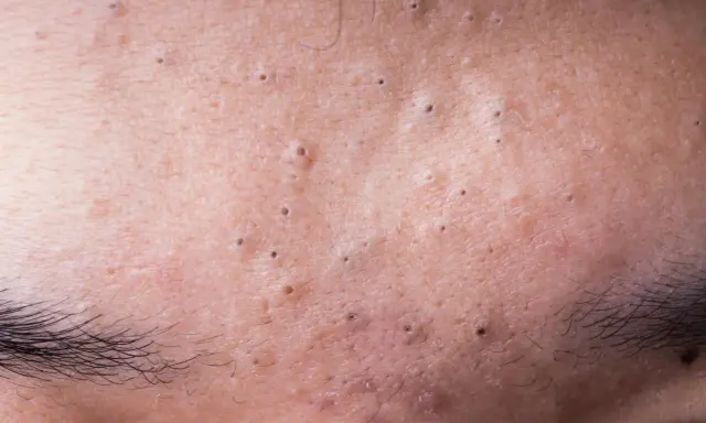 Gros plan sur la peau du front, révélant de minuscules boutons et des pores dilatés, avec des sourcils foncés en bas.