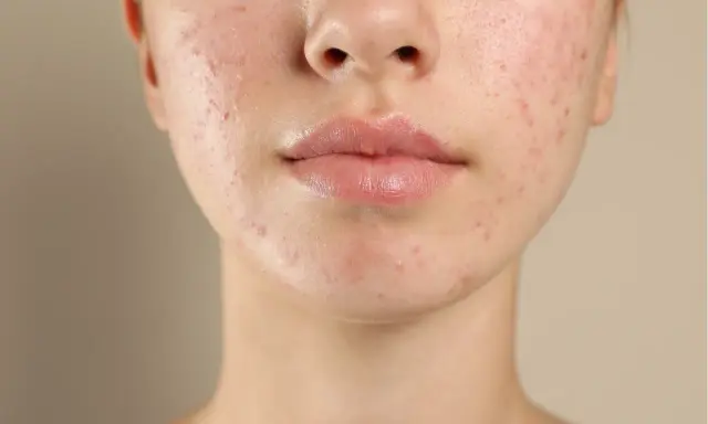 Visage d'une jeune femme avec une peau à tendance acnéique. L'acide salicylique fait ressortir les boutons, révélant une peau en cours de traitement.