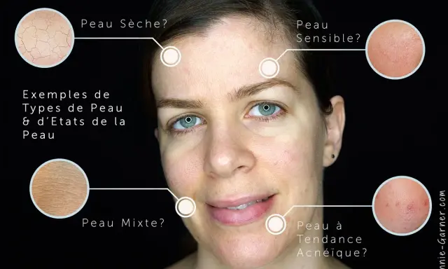 Identifier les types de peau : sèche, sensible, mixte, acnéique. Comment savoir si on a la peau grasse ? L'image montre des exemples visuels.