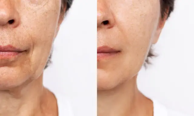 Comparaison avant/après : la peau du visage montre une réduction visible des ridules et une amélioration de la texture.