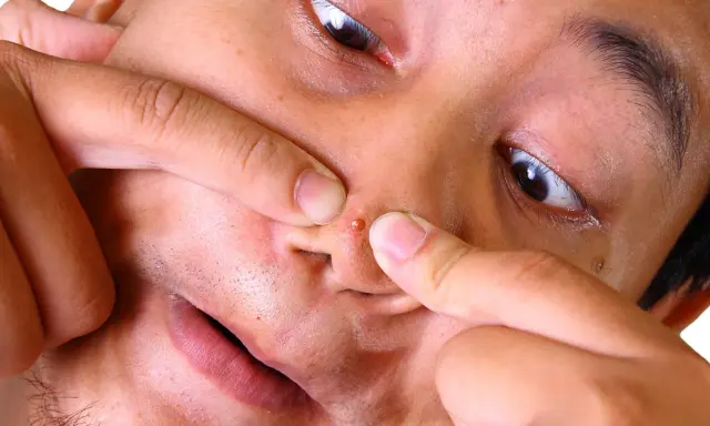 Doigts pinçant un gros bouton noir sur la peau du nez, gros plan sur le visage.