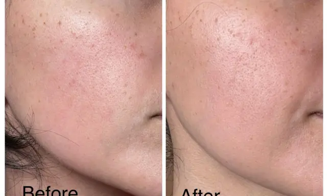 Avant/après : peau avec rougeurs et taches, avant utilisation d'acide azélaïque. Après, la peau est plus lisse, sans danger apparent.