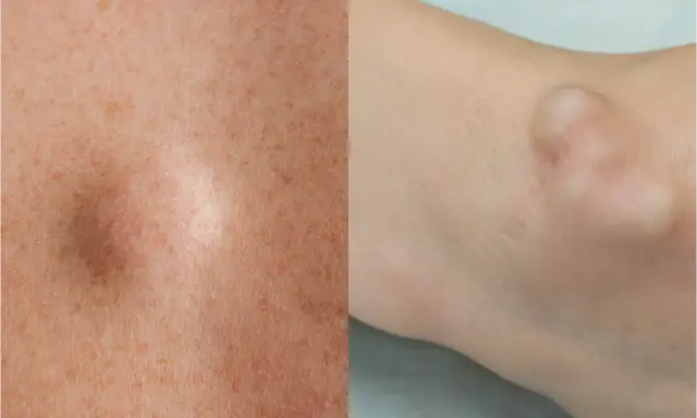 Gros plan sur une peau avec des taches de rousseur et une boule de graisse sous-cutanée sur le bras.