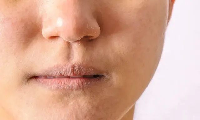 Peau sèche et squameuse autour du nez et des lèvres, signe d'un manque de sébum.