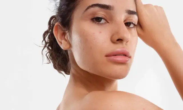 Visage d'une jeune femme avec quelques imperfections, illustrant ce qu'est la peau mixte.