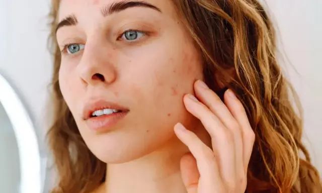 Jeune femme examinant son visage dans un miroir, avec des rougeurs et des imperfections. Comment savoir notre type de peau pour mieux en prendre soin.