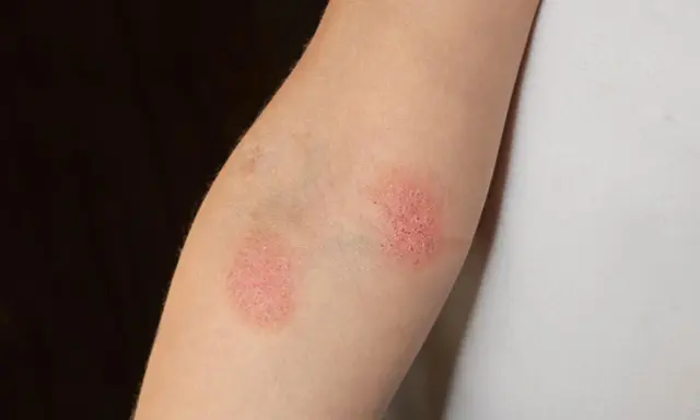 Deux plaques rouges sur un bras, ressemblant à un bouton rouge avec point blanc, indiquent une irritation cutanée.