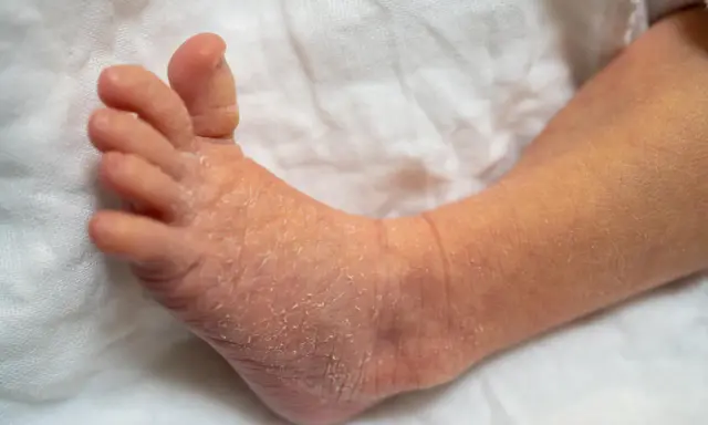 Pied de bébé avec peau sèche et squameuse, évoquant le psoriasis bébé.
