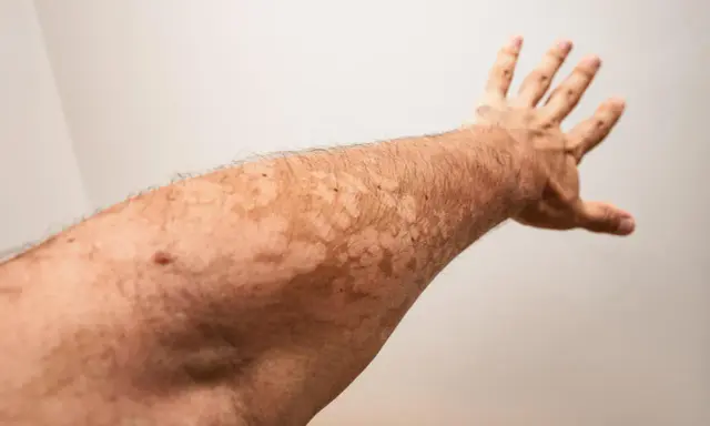 Bras tendu révélant des taches claires dues à un vitiligo léger.