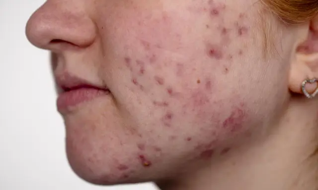 Gros plan sur le visage d'une jeune femme, montrant une peau rougie avec de nombreux comédons et boutons d'acné.