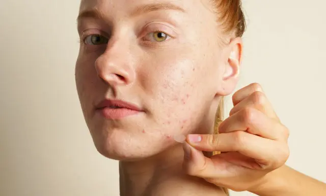 Une main applique un petit pansement transparent sur un bouton d'acné sur le visage d'une jeune femme rousse.