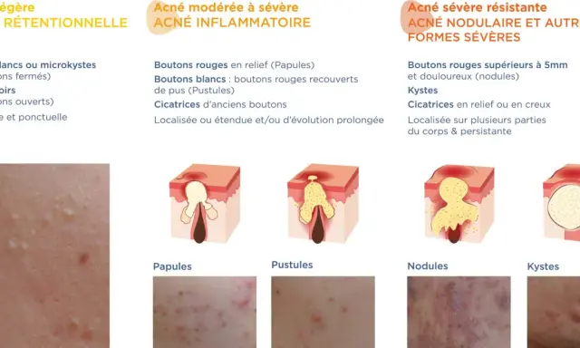 Illustration des différents types d'acné : rétentionnelle, inflammatoire, nodulaire et kystique. Chaque type d'acné est décrit avec ses caractéristiques et représenté par des schémas et des photos.