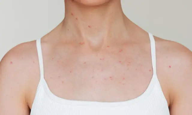 Poitrine et cou d'une personne portant un débardeur blanc, avec de nombreux petits boutons rouges visibles sur la peau.