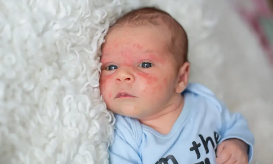 Visage de bébé avec un bouton de lait, sur une couverture blanche et moelleuse.
