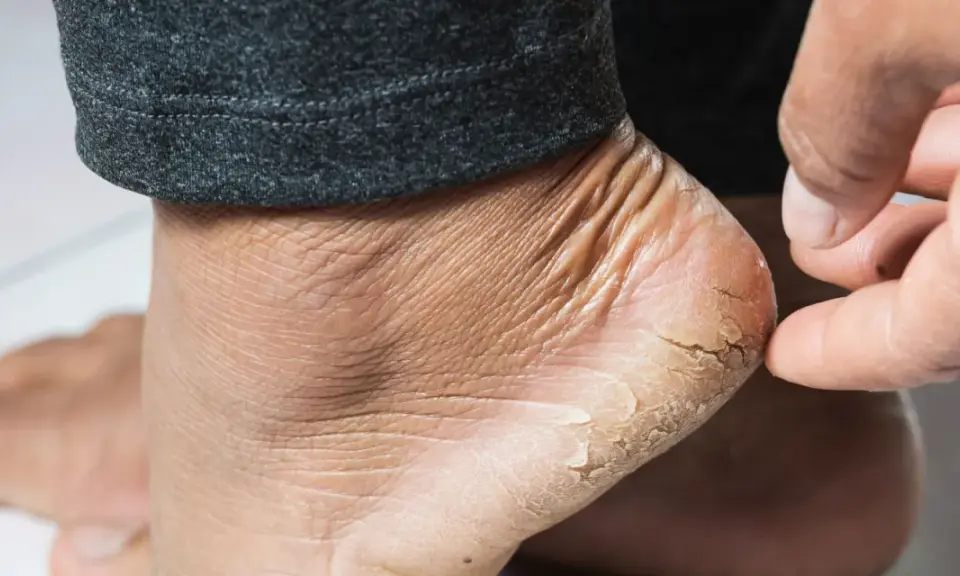 Gros plan sur un talon sec et craquelé, signe de xérose pied. La peau est rugueuse et des lambeaux se détachent.