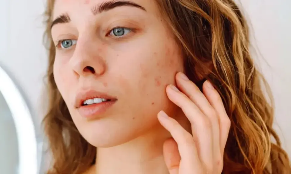 Jeune femme examinant son visage dans un miroir, avec des rougeurs et des imperfections. Comment savoir notre type de peau pour mieux en prendre soin.