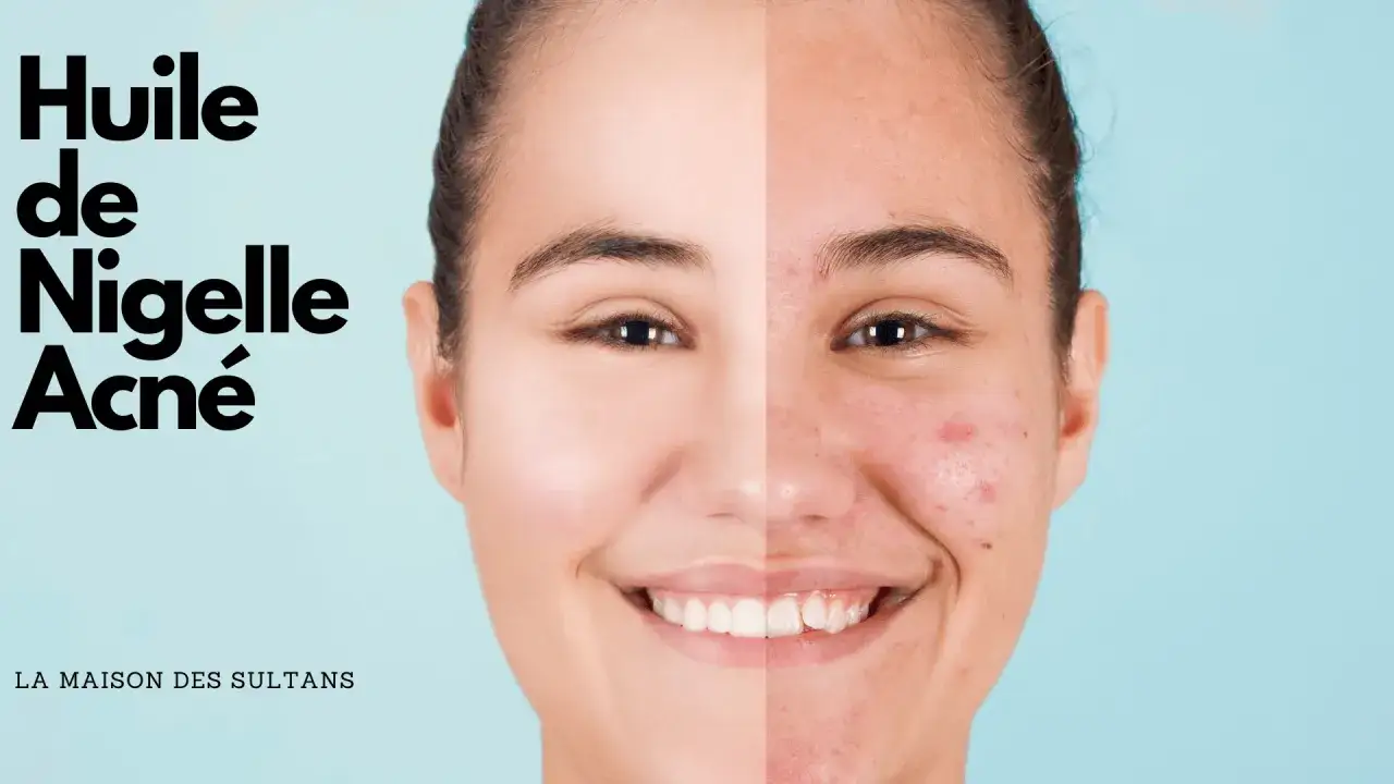 Visage divisé montrant une peau nette et une peau avec de l'acné. Le texte indique