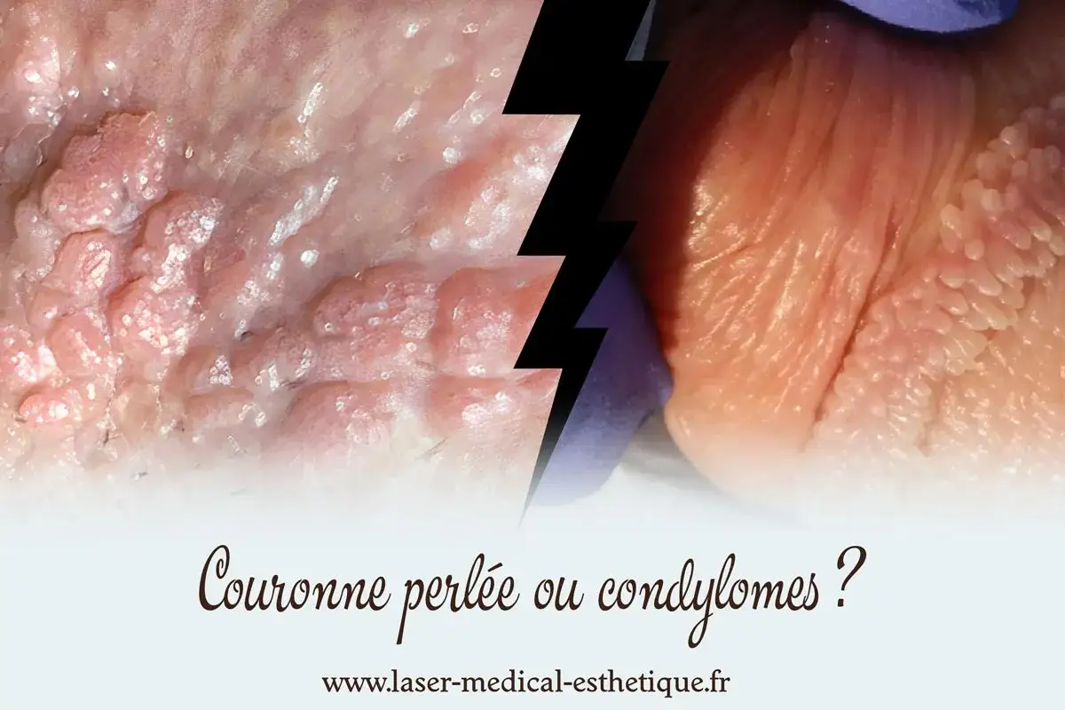 Gros plan sur des papules perlées et des condylomes, deux affections cutanées distinctes.