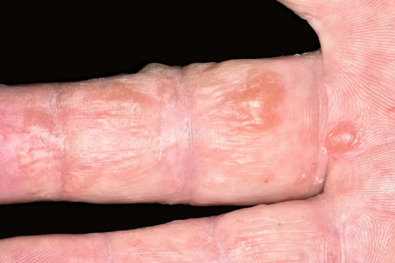 Main affect&eacute;e par des plaques rouges et s&egrave;ches, signes d'ecz&eacute;ma. La peau est irrit&eacute;e et pr&eacute;sente des l&eacute;sions.