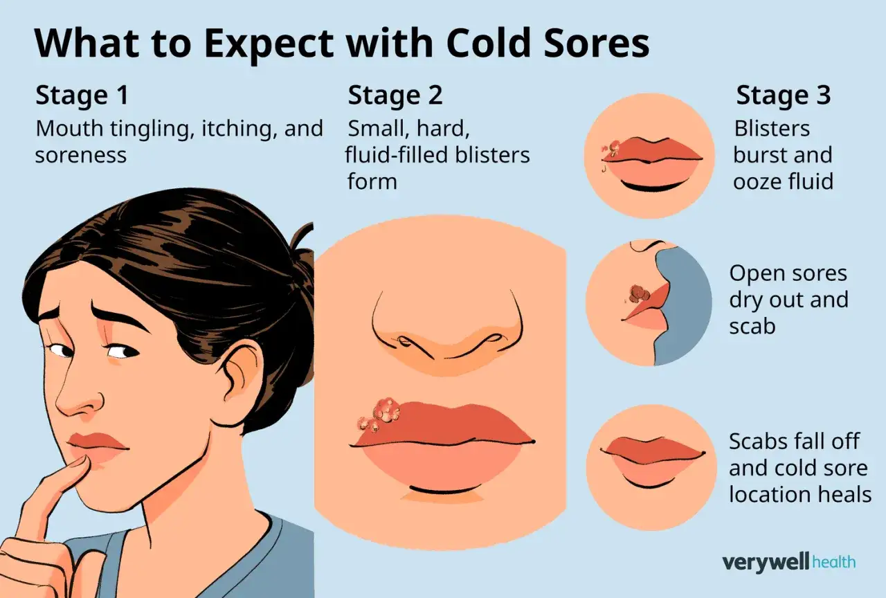 Étapes d'un herpes labial : picotements, vésicules, plaies qui sèchent et cicatrisation. Que faire ?