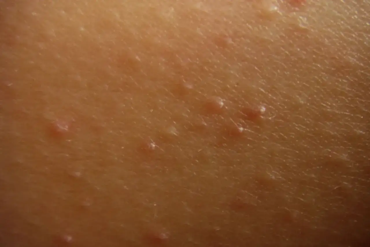 Gros plan sur la peau d'un bras, montrant un petit bouton sur les bras allergie, avec plusieurs petites bosses rouges et blanches.