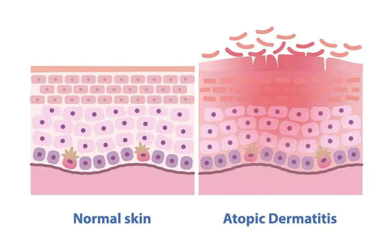 Comparaison de la peau normale et de la peau atopique. La peau normale est lisse, tandis que la peau atopique montre une inflammation et des squames, signes d'eczéma.