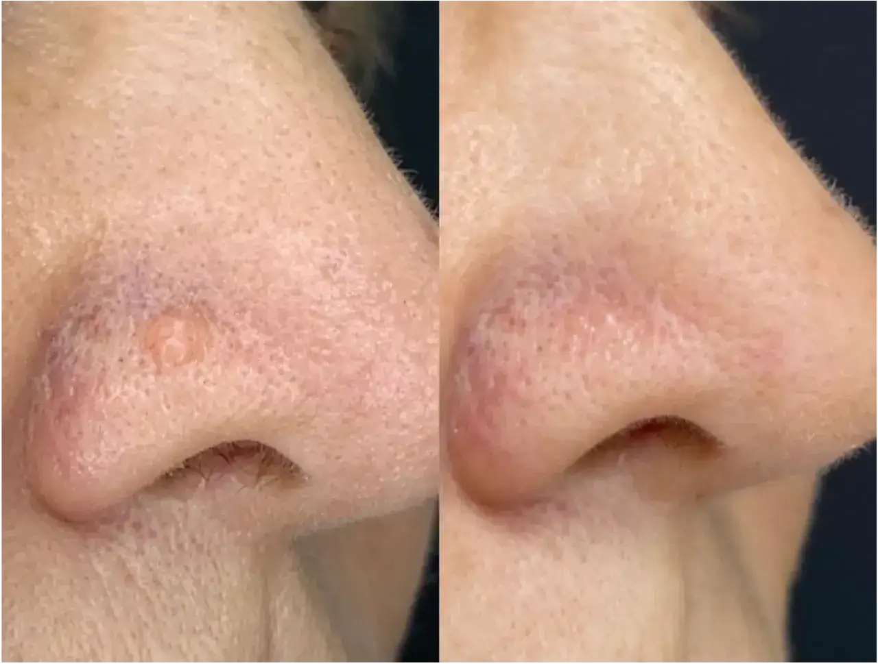 Comparaison avant/après d'une papule fibreuse du nez traitée. La lésion a disparu, laissant la peau lisse.
