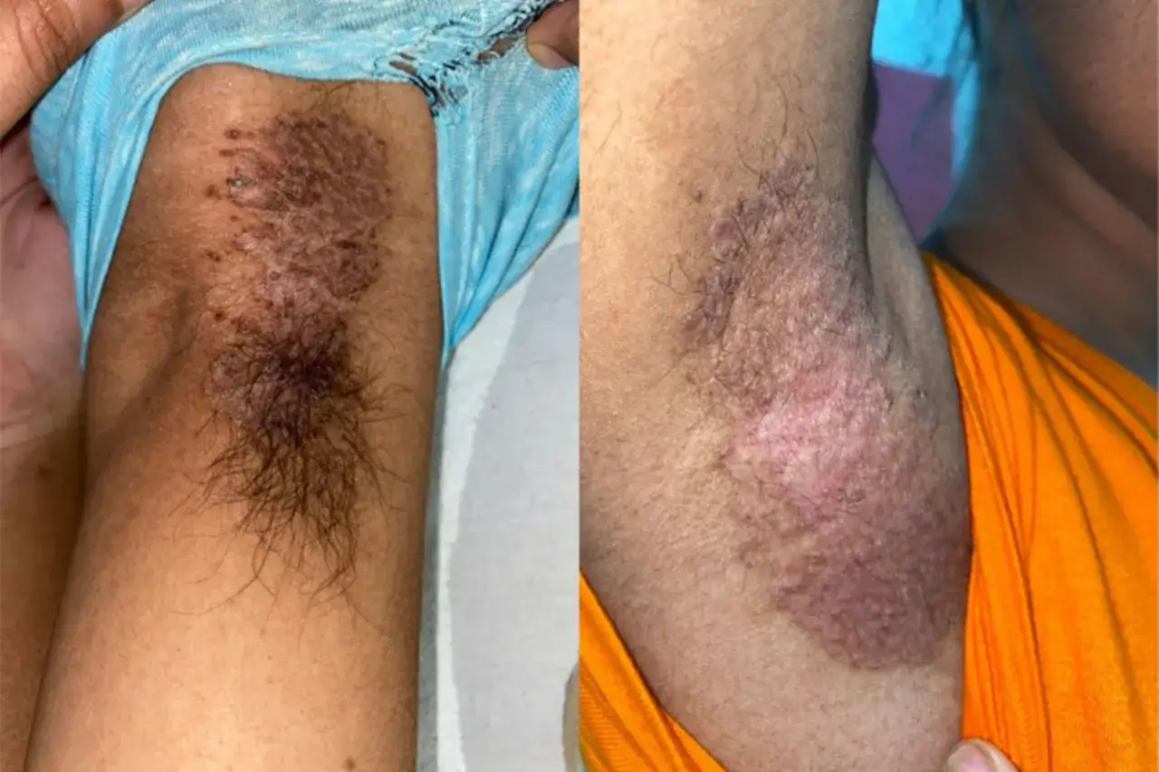 Aisselle gauche et droite montrant des plaques rouges et squameuses, caract&eacute;ristiques du psoriasis invers&eacute;.