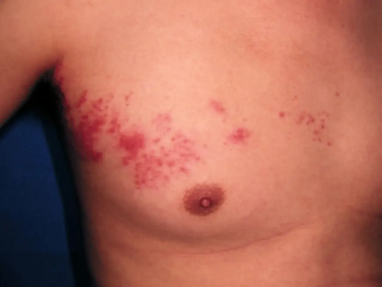 &Eacute;ruption cutan&eacute;e rouge avec un bouton sur le torse, ressemblant &agrave; des v&eacute;sicules group&eacute;es.