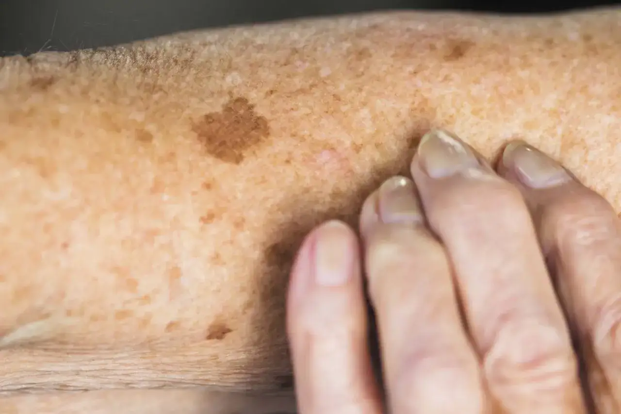Gros plan sur une peau marqu&eacute;e par des taches de vieillesse. Des doigts aux ongles clairs effleurent doucement la peau.