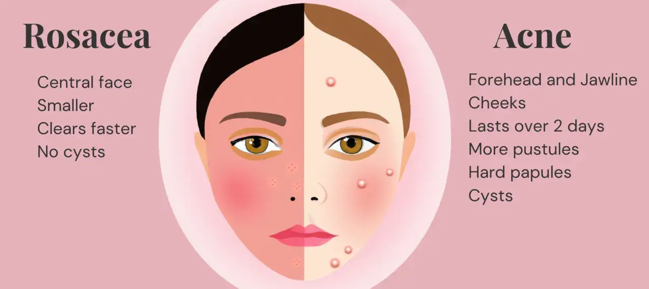 Visage divis&eacute; : &agrave; gauche, rougeurs et petits boutons typiques de l'acn&eacute; rosac&eacute;e ; &agrave; droite, boutons plus gros et pustules d'acn&eacute;.