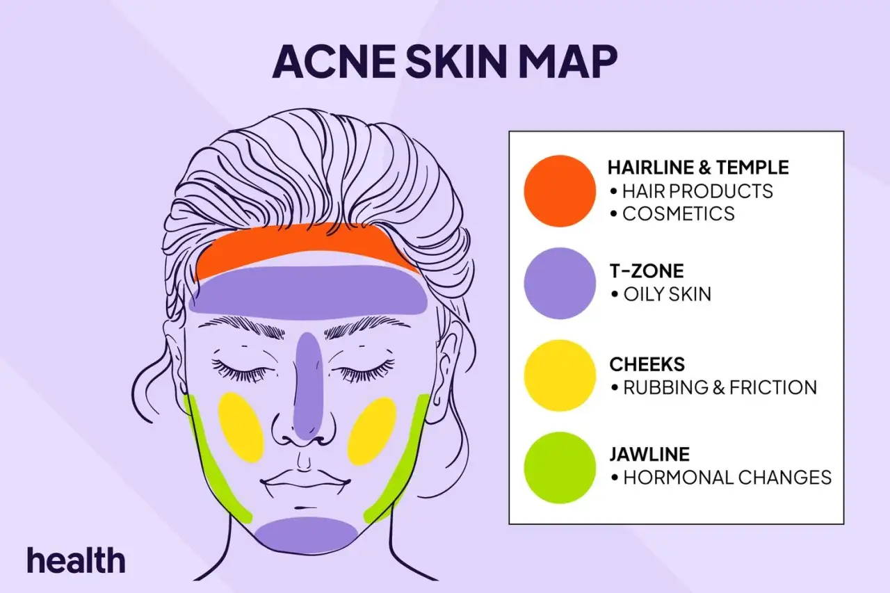 Carte de l'acné : la mâchoire, zone de changements hormonaux, peut être affectée par la progestérone.