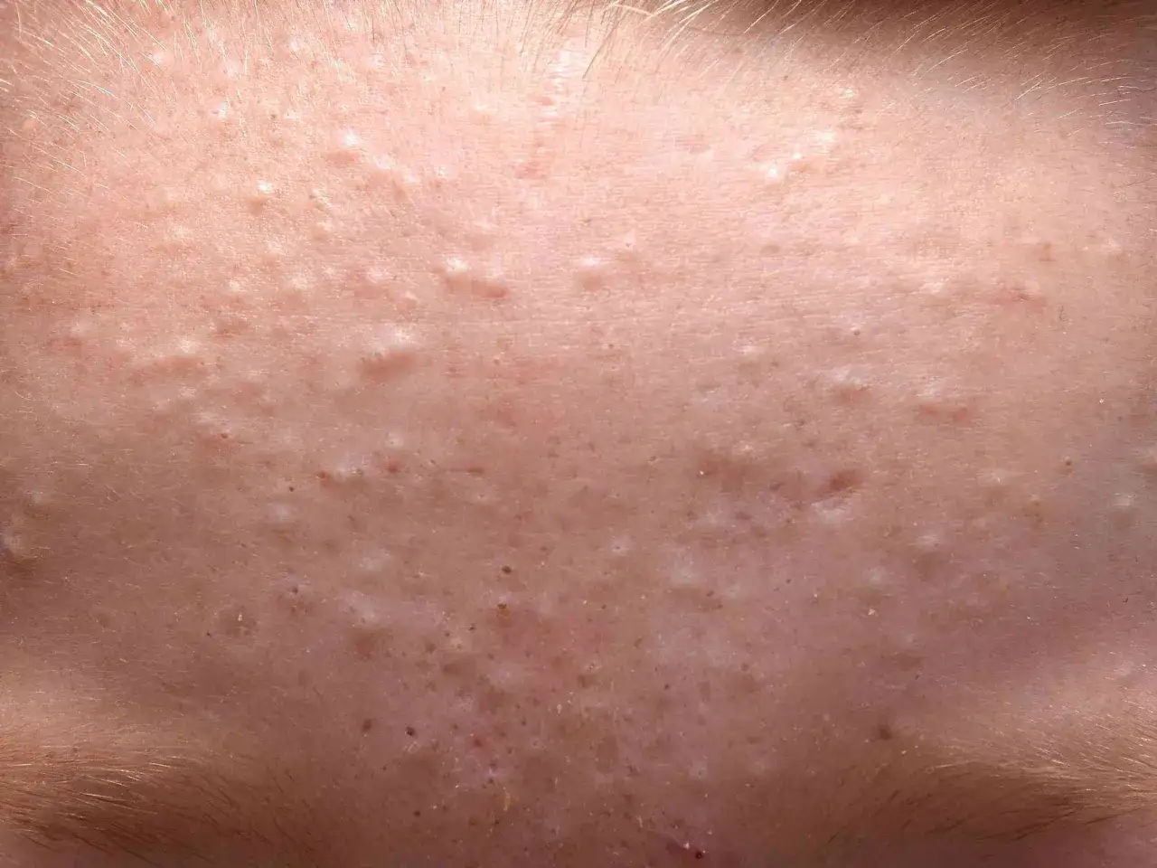 Gros plan sur une peau présentant de nombreux petits boutons blancs, certains semblant prêts à percer. Des poils fins sont visibles sur les bords.