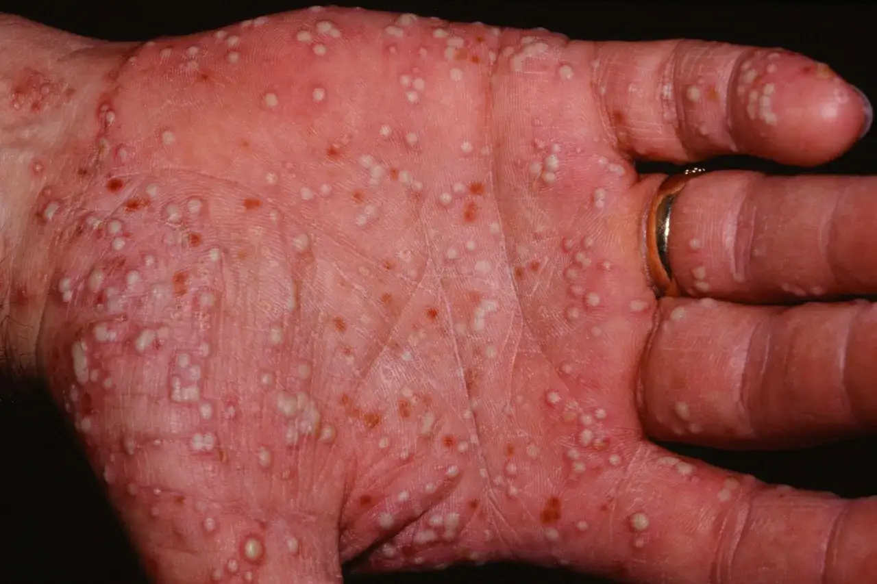 Main d'une personne atteinte de psoriasis palmo plantaire, pr&eacute;sentant de nombreuses pustules et rougeurs sur la paume et les doigts.