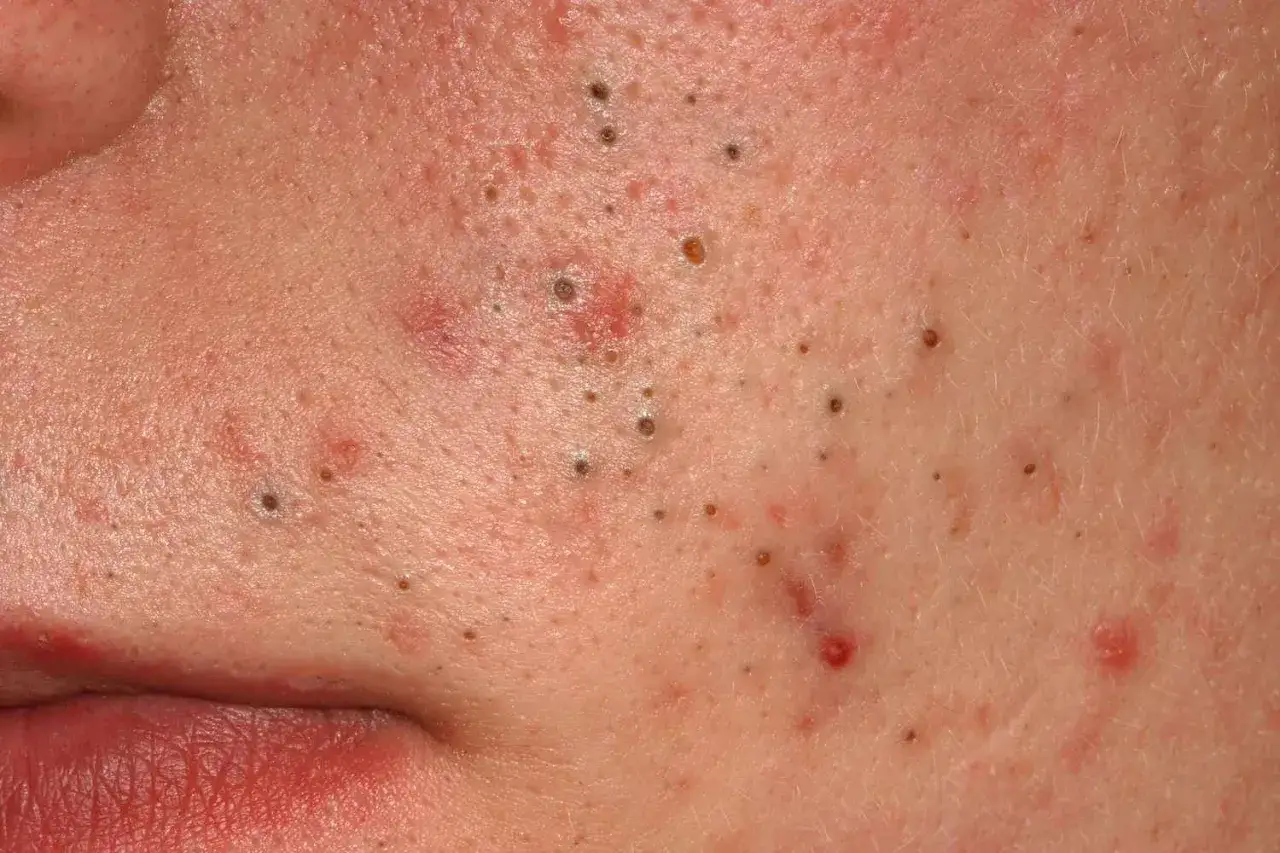Gros plan sur une peau présentant de nombreux points noirs, certains semblant être des points noirs douloureux, avec des rougeurs et des imperfections.