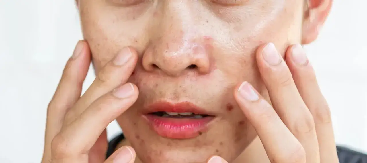 Visage avec acné et points noirs, mains touchant la peau. Comment savoir si on a la peau grasse ? Brillance et imperfections sont des signes.