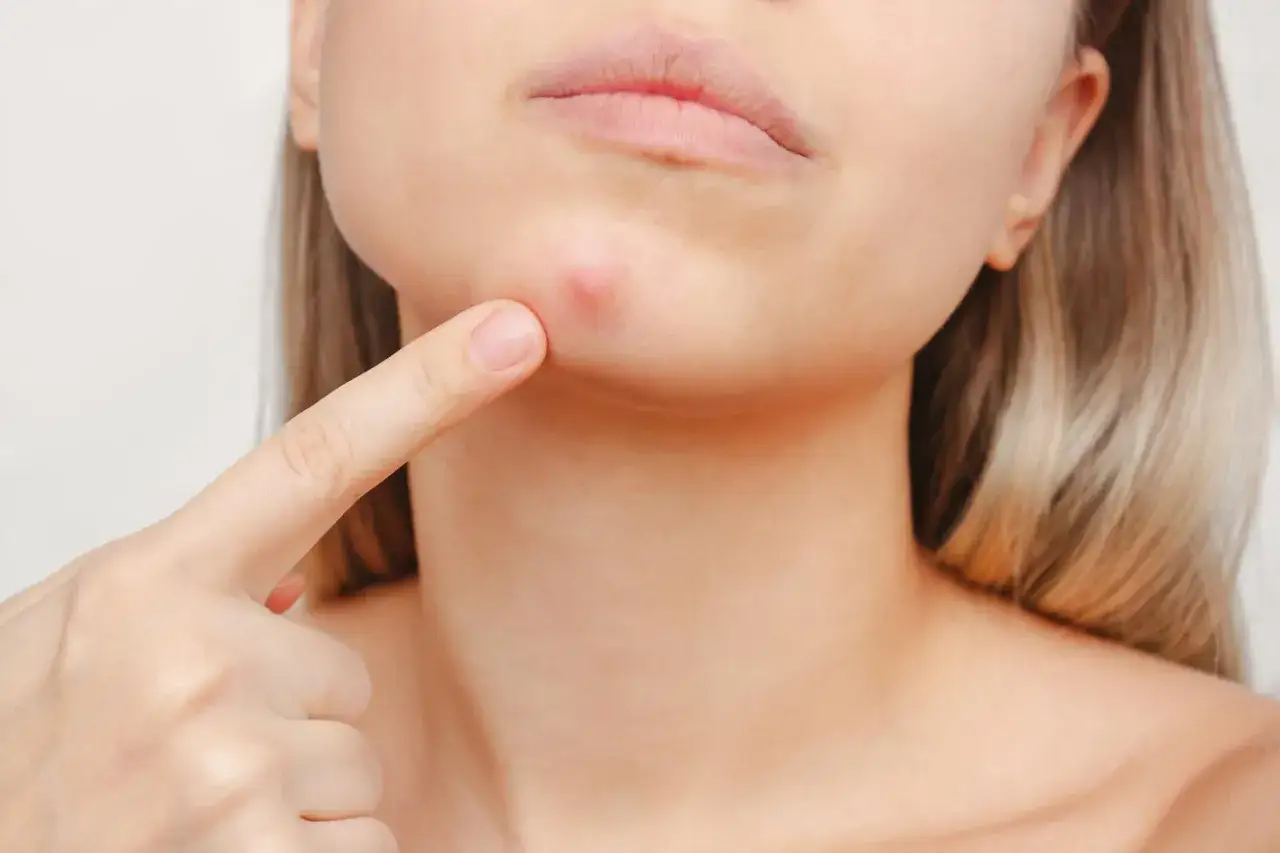 Un doigt pointe un bouton rouge sur le bas du visage, près de la lèvre inférieure.