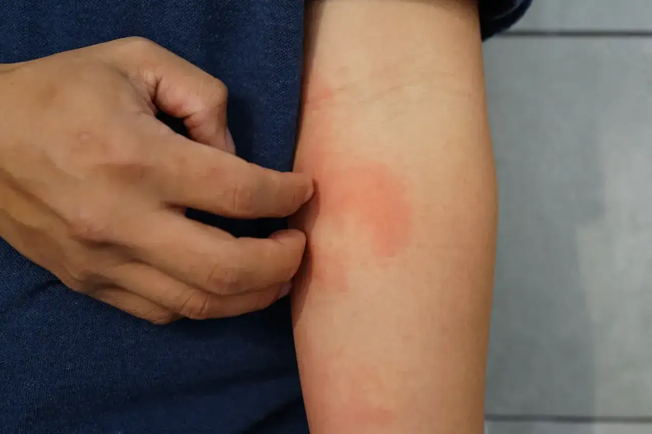 Main qui se gratte sur un bras atteint d'eczéma. L'huile essentielle de tea tree pourrait soulager ces démangeaisons.
