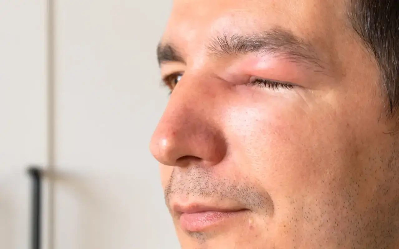 Paupi&egrave;re gonfl&eacute;e et rouge, signe d'une plaque rouge sous les yeux allergie. L'&oelig;il est partiellement ferm&eacute;.