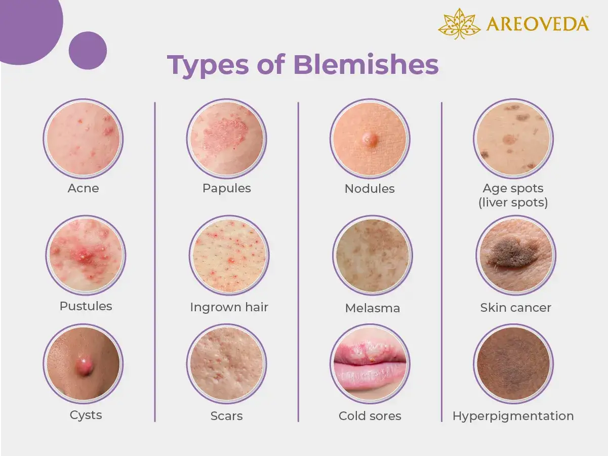 Illustration montrant diff&eacute;rents types de bouton sur la peau : acn&eacute;, papules, nodules, taches de vieillesse, pustules, poils incarn&eacute;s, m&eacute;lasma, cancer de la peau, kystes, cicatrices, boutons de fi&egrave;vre, hyperpigmentation.