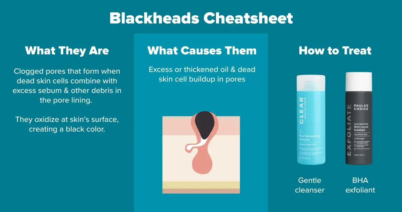 Infographie expliquant l'acné rétentionnelle : causes (excès de sébum, cellules mortes), description (pores obstrués s'oxydant) et traitements (nettoyant doux, exfoliant BHA).